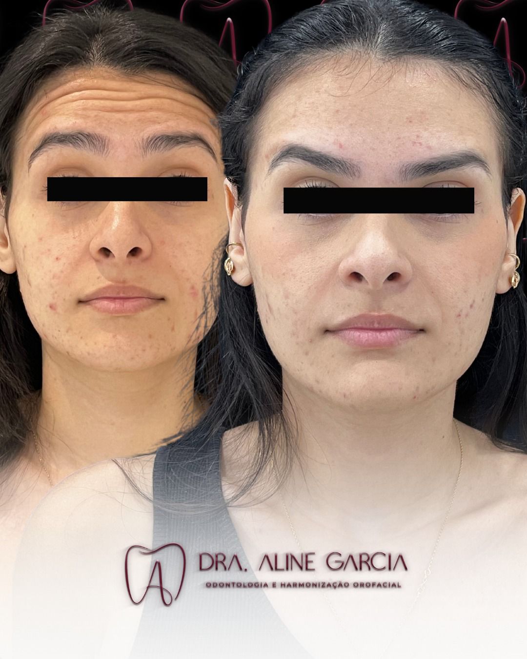 Antes e depois mostrando uma paciente sem marcas de expressão na testa, evidenciando os resultados de um tratamento estético.