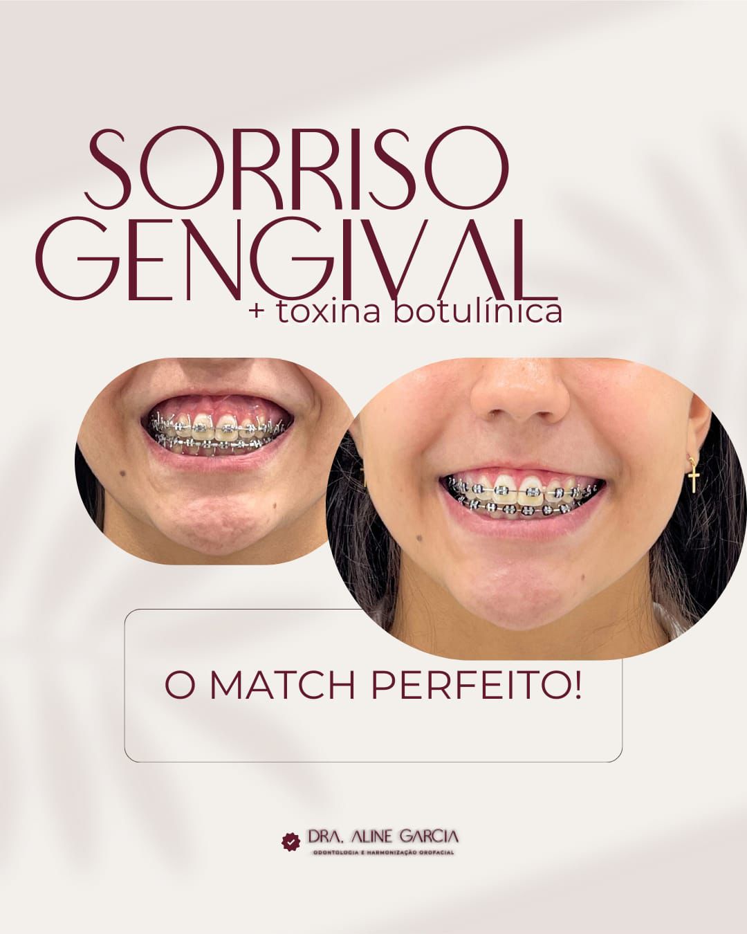 Antes e depois da correção de sorriso gengival, mostrando a harmonização do sorriso e redução da exposição gengival.