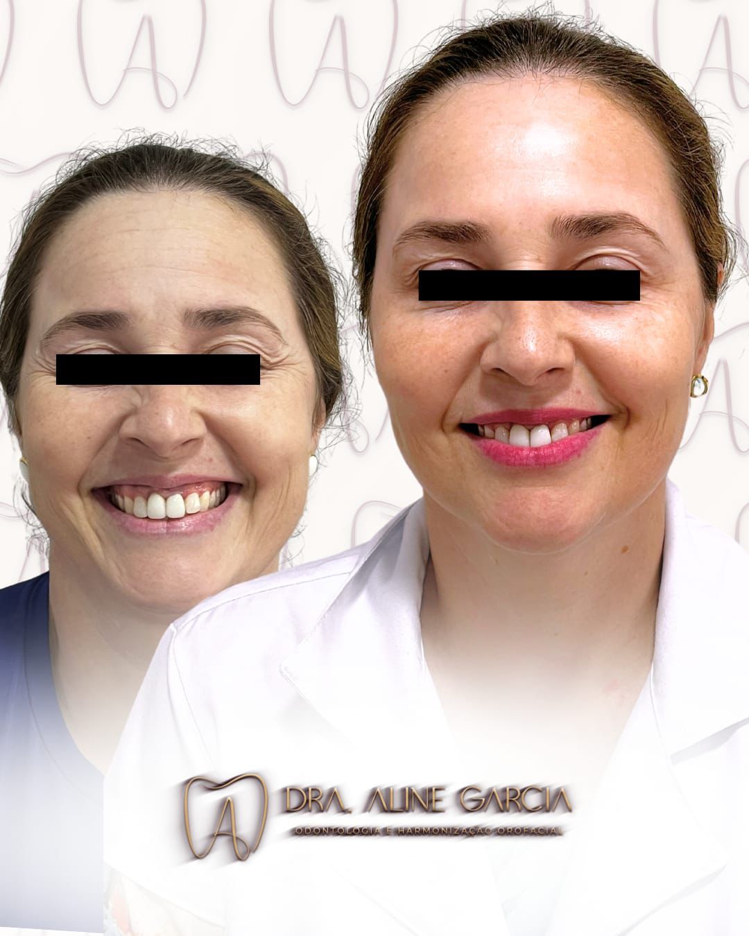 Antes e depois do procedimento nos lábios de uma paciente sorrindo, mostrando aumento de volume e contorno definido.