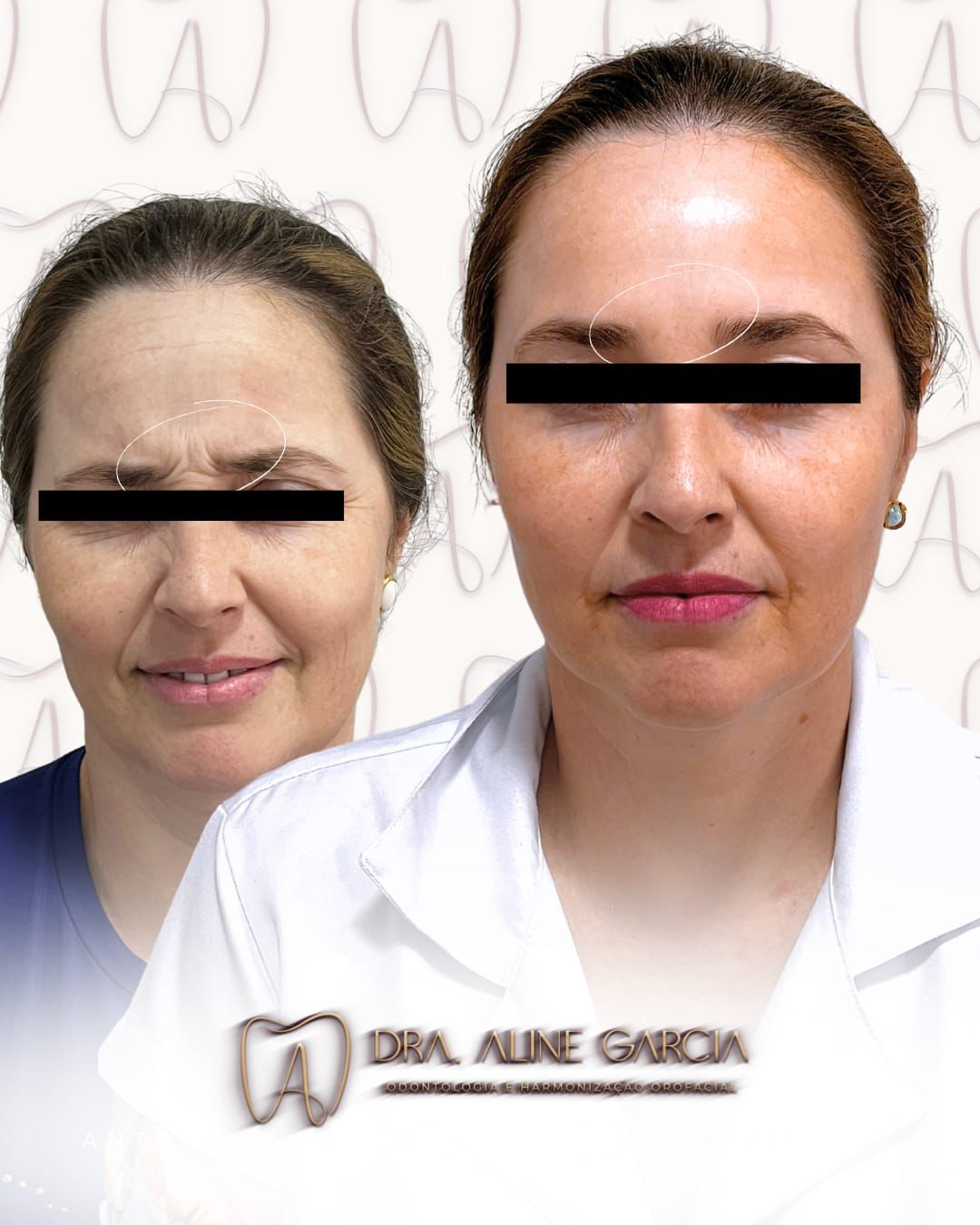 Antes e depois do procedimento nos lábios de uma cliente, mostrando o aumento de volume e contorno mais definido.