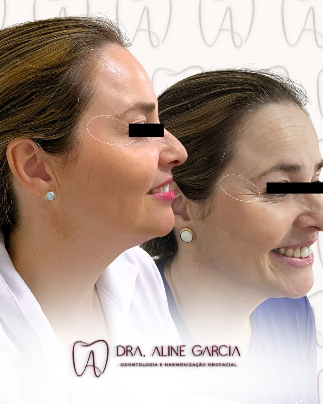 Antes e depois do procedimento nos lábios de uma paciente sorrindo de perfil, mostrando aumento de volume e definição.