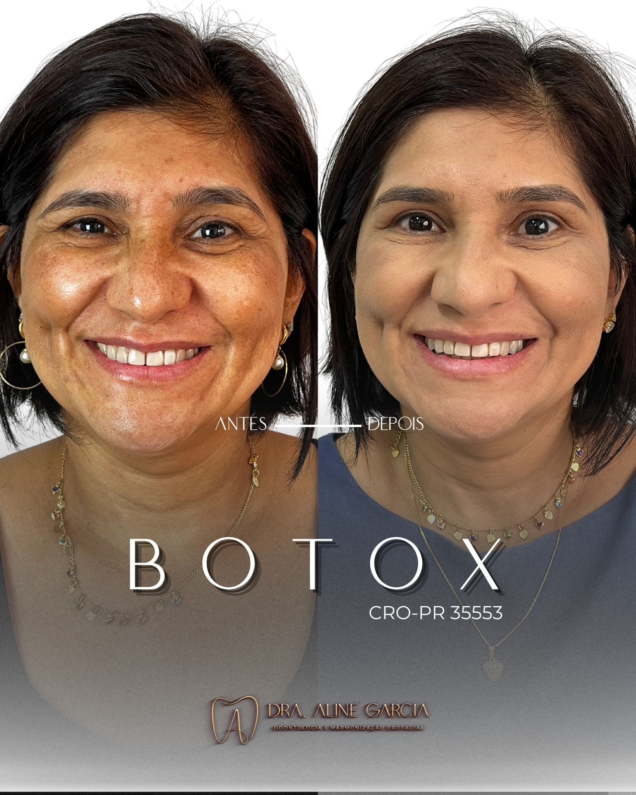 Antes e depois de paciente feminina fazendo várias expressões faciais, mostrando a eficácia do procedimento e resultados naturais.