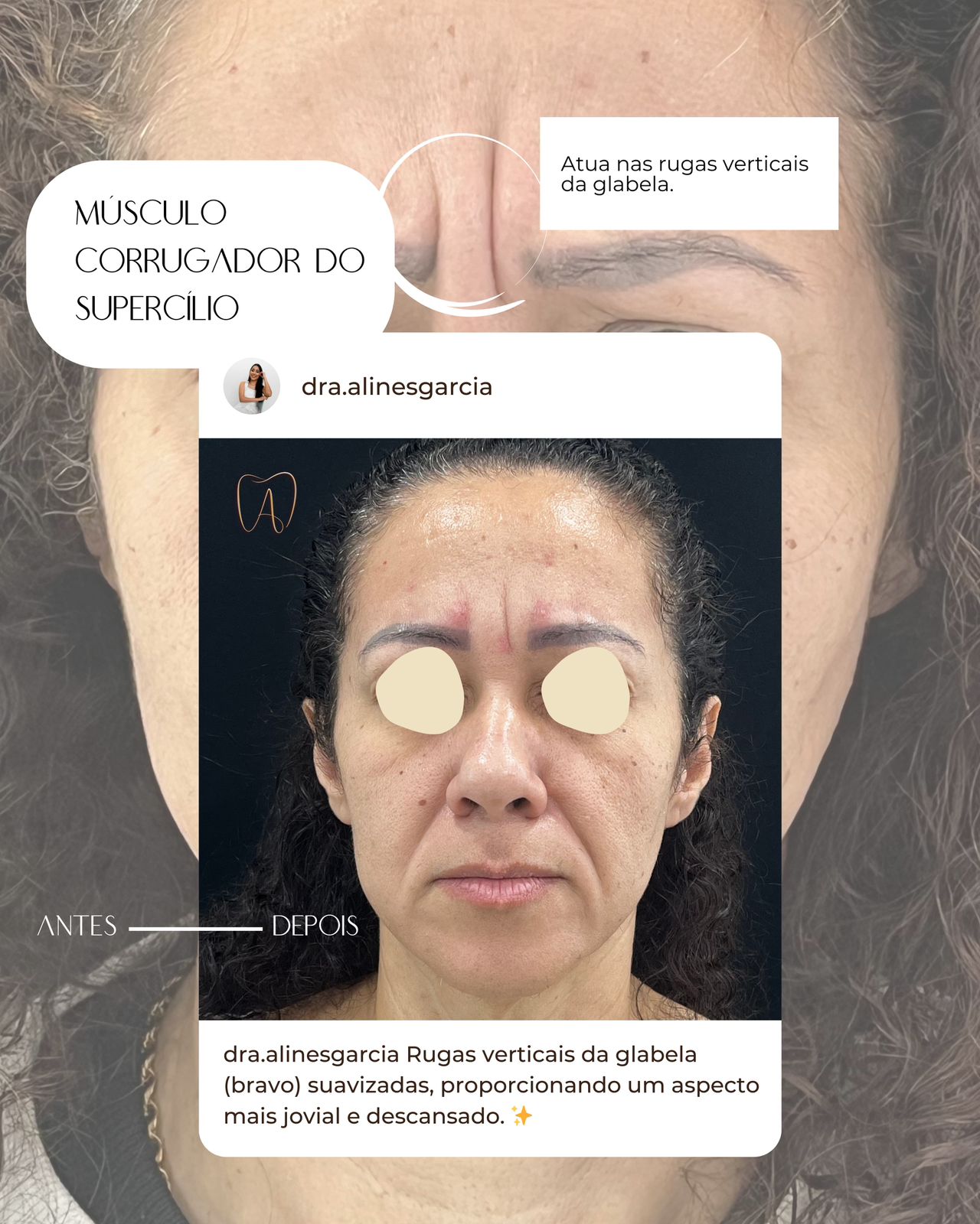 Antes e depois de uma paciente corrigindo rugas e marcas de expressão, mostrando a suavização e rejuvenescimento da pele.