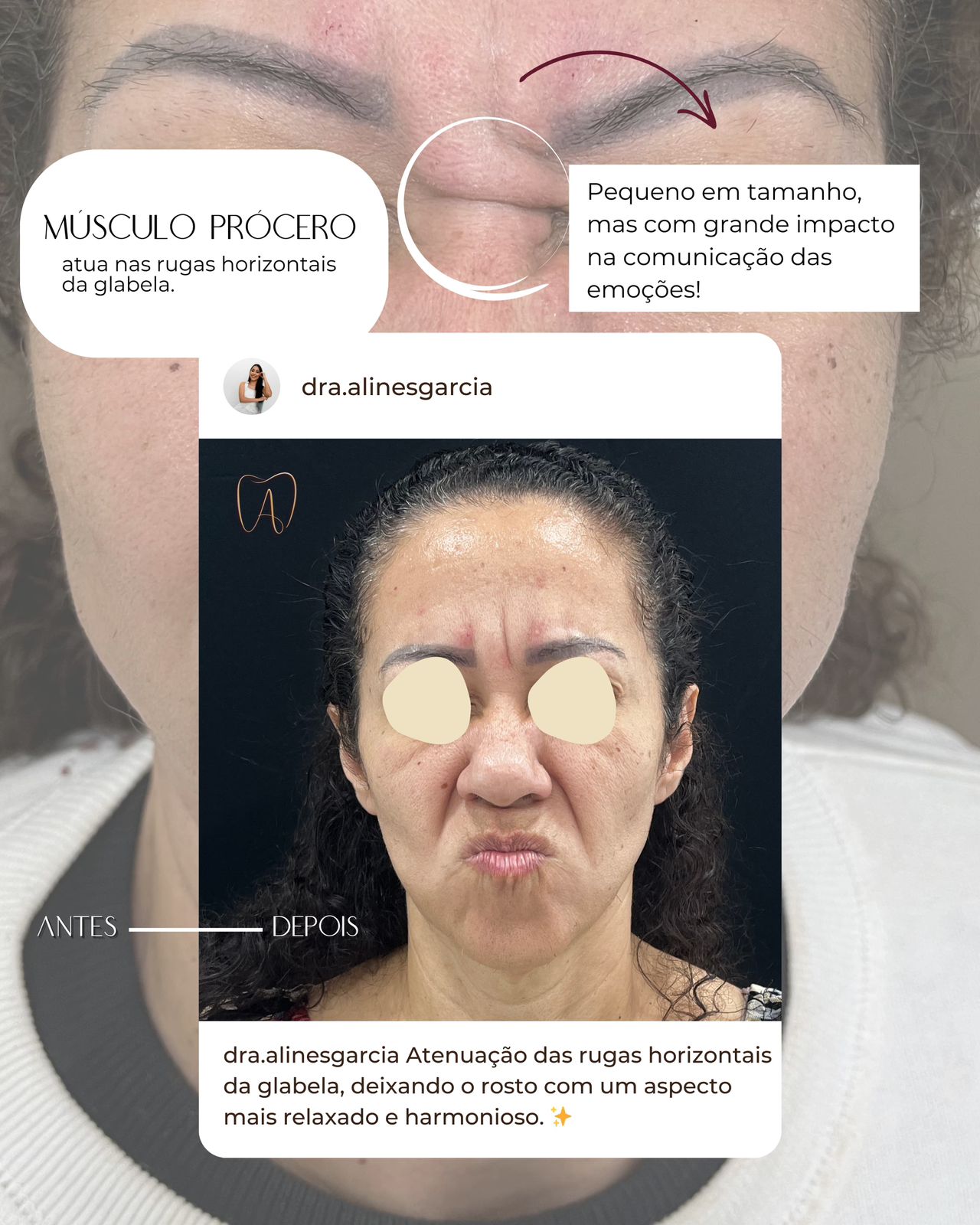 Antes e depois de uma paciente corrigindo rugas e marcas de expressão, mostrando resultados visíveis e naturais