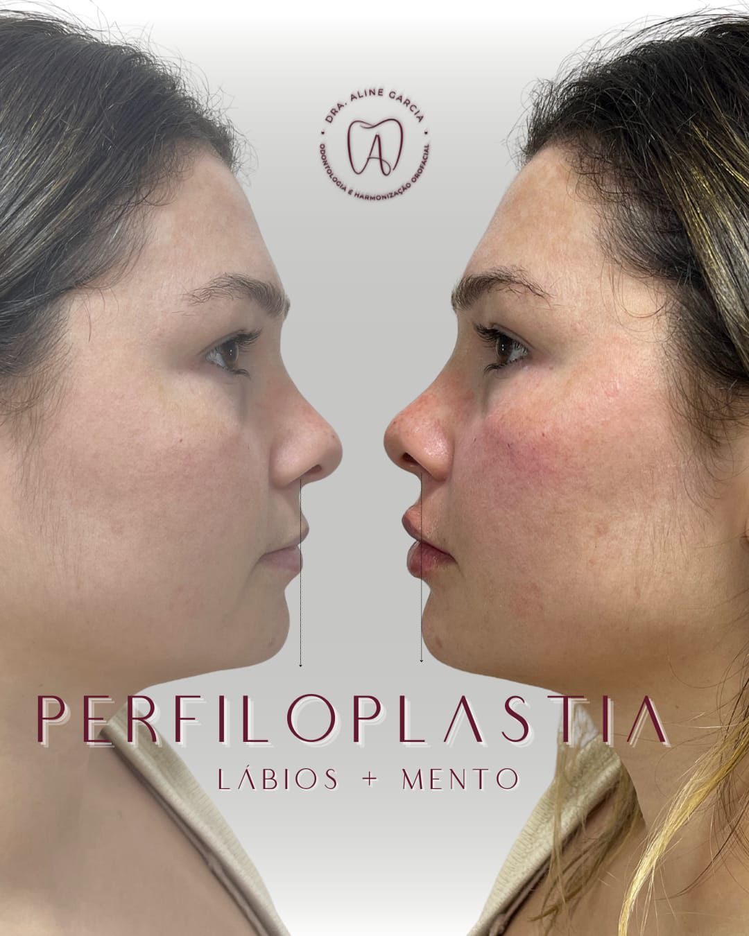 Antes e depois de paciente feminina que realizou perfiloplastia, mostrando a melhoria no contorno facial e equilíbrio do perfil.